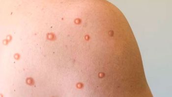 Confirmaron el primer caso de la nueva variante de viruela símica en Argentina. Confirmaron el primer caso de la nueva variante de viruela símica en Argentina.