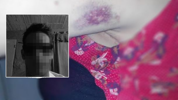 Una mujer denuncia que su ex le pegó durante su tratamiento oncológico