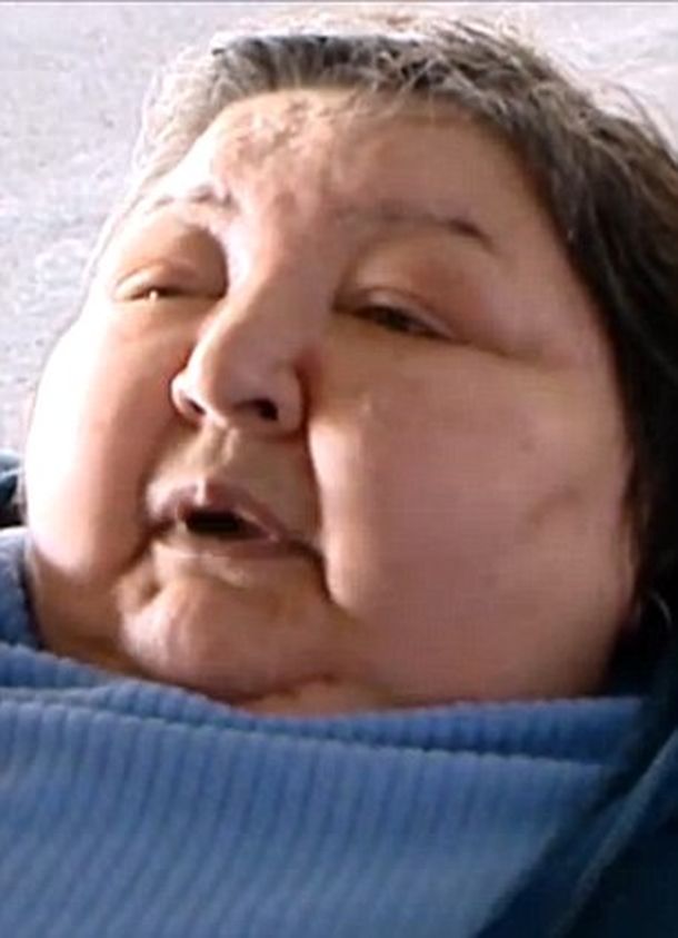 Una obesa murió porque las aerolíneas se negaron a transportarla