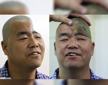 Reconstruirán el cráneo de un hombre con impresoras 3D