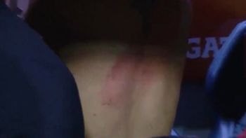 el medico de river: tienen quemaduras de primer grado el medico de river: tienen quemaduras de primer grado