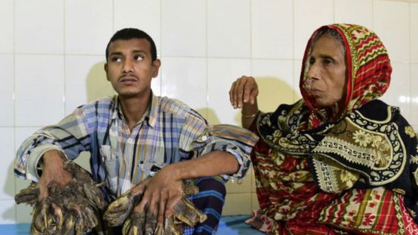 El hombre árbol pide que le amputen las manos