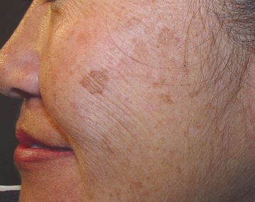 Los 5 hábitos que provocan manchas marrones en la piel