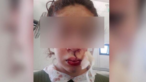 Otro caso de violencia en un control policial: golpearon a una chica hasta sacarle los dientes