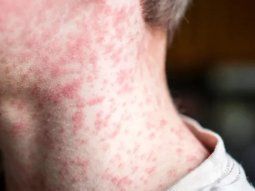 confirman en la ciudad el primer caso de sarampion en argentina en 2026 confirman en la ciudad el primer caso de sarampion en argentina en 2026