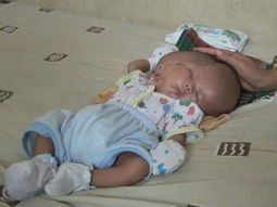 Un bebé nació con dos cabezas en Indonesia&nbsp;