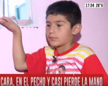 Conmovedor: le trasplantaron un dedo del pie a la mano tras la detonación de un explosivo