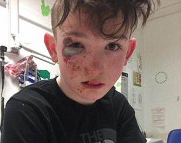 Se quemaron con un peligroso químico y dijeron que los habían atacado