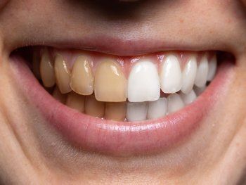 El truco casero para blanquear tus dientes rápido y fácil