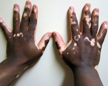 Quemaduras solares y vitiligo