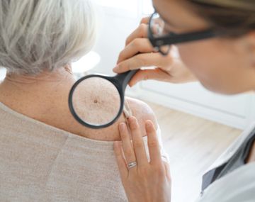 Crecieron 20% las consultas por cáncer de piel: cómo cuidarse del sol