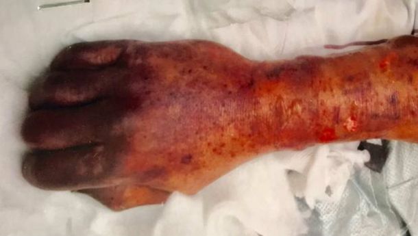Un hombre murió por una infección que contrajo por un beso de su perro