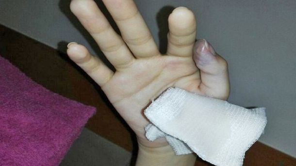 Fue a la guardia por un cuadro gripal y casi le tienen que amputar un dedo