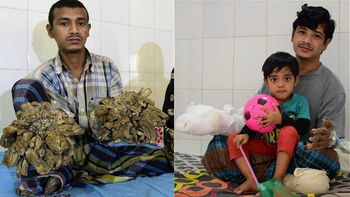 Abul es el hombre árbol Abul es el hombre árbol