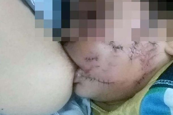 Una nena fue atacada y casi desfigurada por el perro del vecino