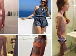 La joven llegó a pesar 31 kilos. La joven llegó a pesar 31 kilos.