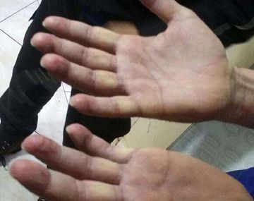 Así estaban las manos de Pérez Corradi cuando fue trasladado a Paraguay