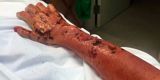 La impresionante foto de Juana Viale con su mano quemada