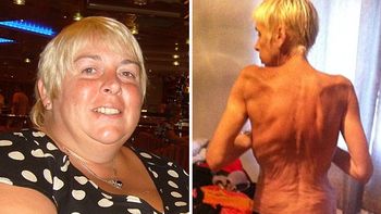 denuncia que se volvio anorexica por un by pass gastrico denuncia que se volvio anorexica por un by pass gastrico