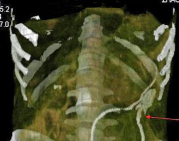 Adicto a la pornografía se introdujo una anguila de medio kilo