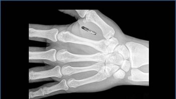 chips en el cuerpo, lo nuevo en tecnologia chips en el cuerpo, lo nuevo en tecnologia