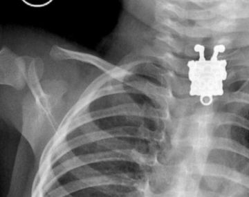 Sobrevive luego  de tragarse un Bob Esponja