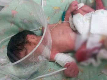 Amputarán el pie a beba quemada en un hospital