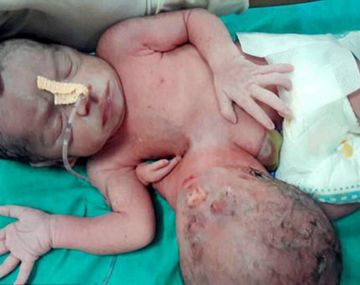 Además de una cabeza en el abdomen, la bebé tenía una tercera mano