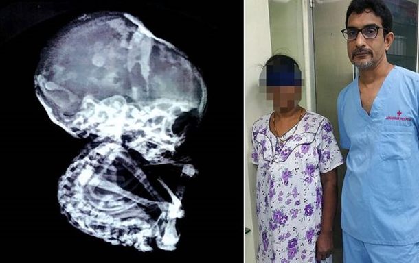 El extraño caso de la mujer que vivió con un feto petrificado durante 15 años