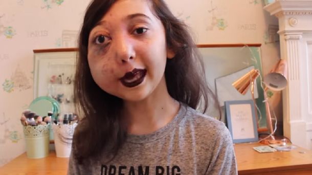 Una youtuber de 11 años inició una campaña por su extraña enfermedad