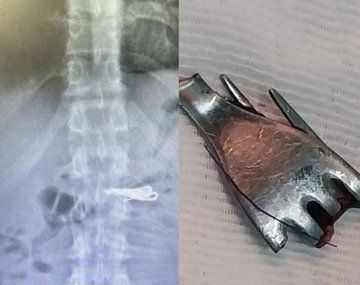 Santa Fe: un preso peligroso se tragó un tenedor y tuvo que ser internado