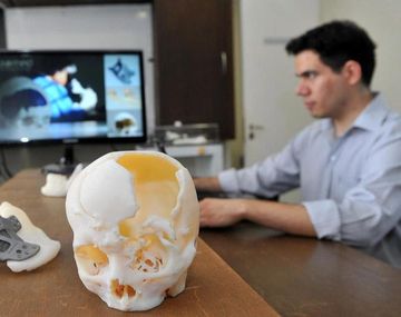 Cada vez más países usan implantes fabricados con impresora 3D