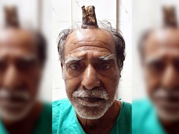 Shyam Lal Yadav tenía un cuerno de 10 centímetros en su cabeza