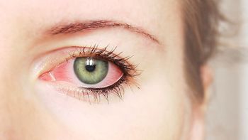 claves para prevenir la alergia ocular
