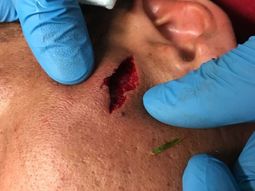 Luciano Fabián Monzón y el corte que sufrió