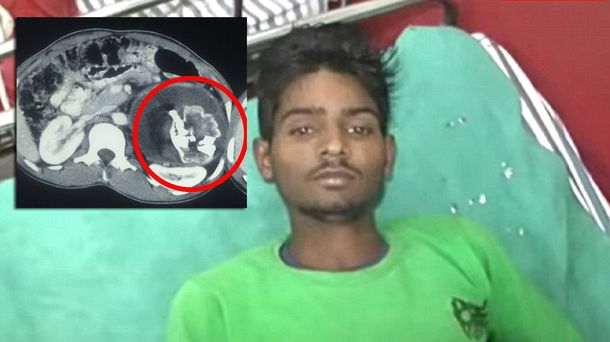 Impresionante: le encontraron el feto de su gemelo en el estómago