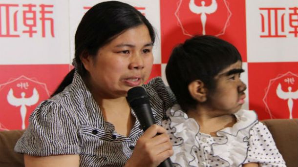 Una niña tiene exceso de vello por extraña enfermedad