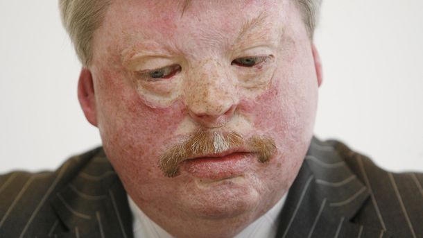 Ingleses sin respeto por nada: se burlan de un discapacitado y veterano de Malvinas