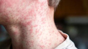 Confirman en la Ciudad el primer caso de sarampión en Argentina en 2026 Confirman en la Ciudad el primer caso de sarampión en Argentina en 2026