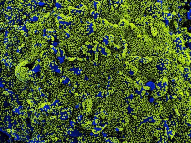Células en azul se muestran infectadas con el coronavirus bajo el microscopio electrónico - NIAID