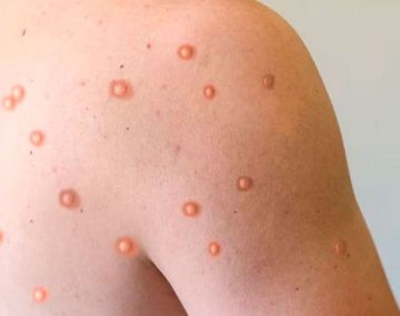 Confirmaron el primer caso de la nueva variante de viruela símica en Argentina.