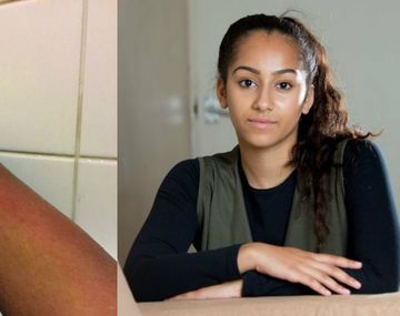 Es alérgica al agua y no puede bañarse sin dolor