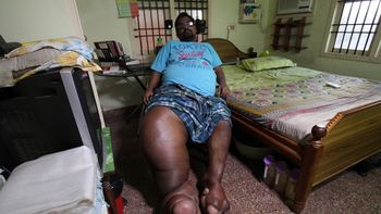 la historia del hombre con piernas de elefantes que pide ayuda para curarse la historia del hombre con piernas de elefantes que pide ayuda para curarse