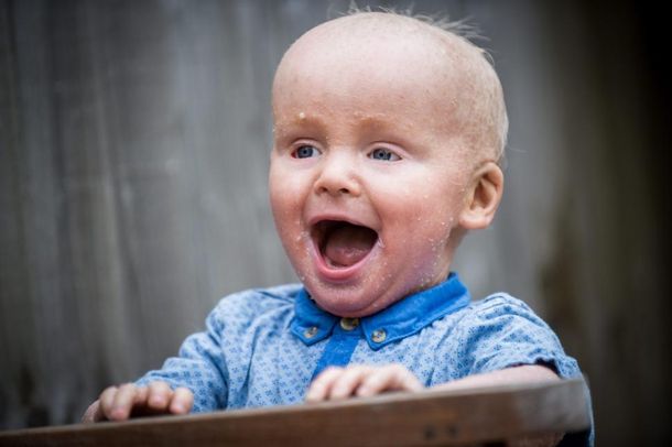 Un bebé de 18 meses tiene la piel como escamas de pescado