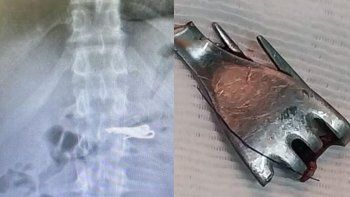 santa fe: un preso peligroso se trago un tenedor y tuvo que ser internado santa fe: un preso peligroso se trago un tenedor y tuvo que ser internado