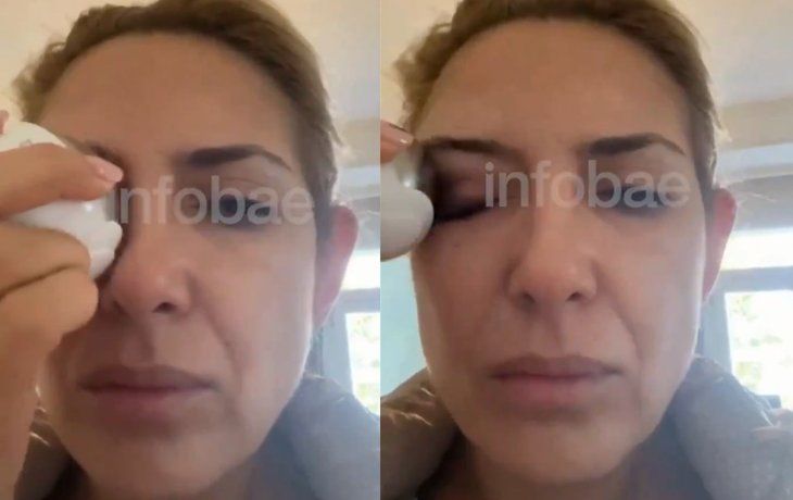 Apareció un video de la ex primera dama con un moretón en el ojo