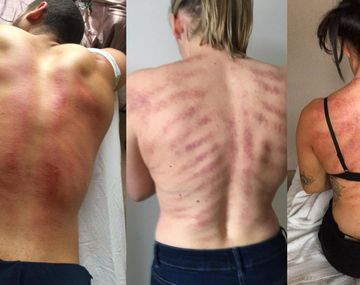 Las marcas parecen poco agradables, pero son por salud