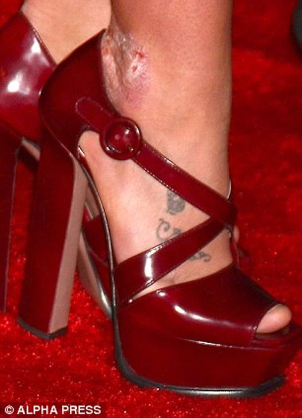 Britney Spears con psoriasis 2