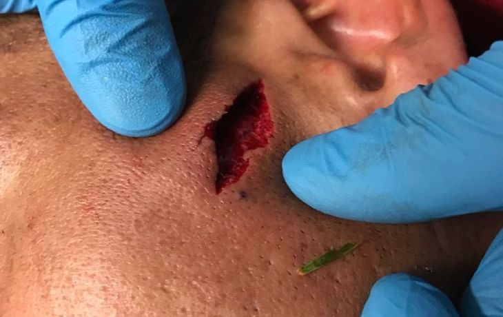 Luciano Fabián Monzón y el corte que sufrió