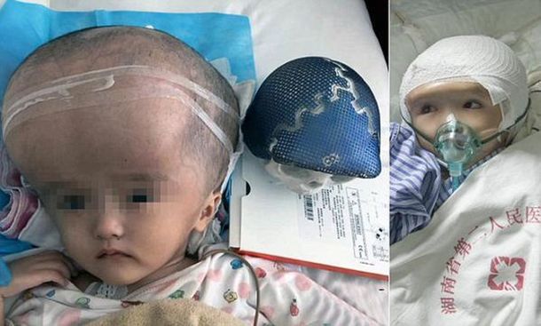 Por primera vez en la historia trasplantan cráneo hecho en impresora 3D a una nena de tres años